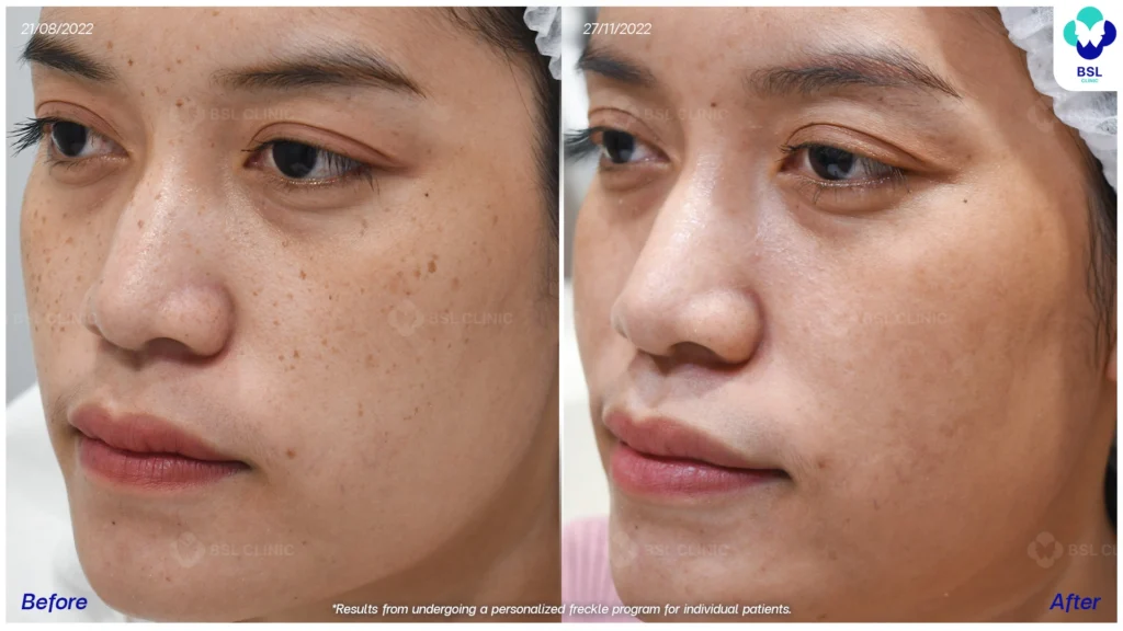 รีวิวรักษากระ