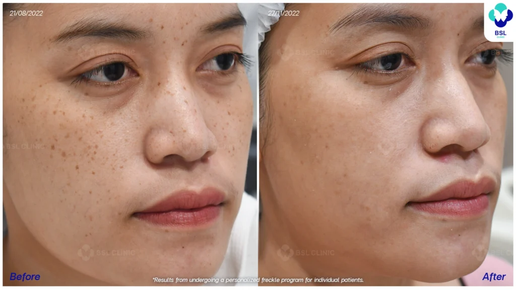 รีวิวรักษากระ