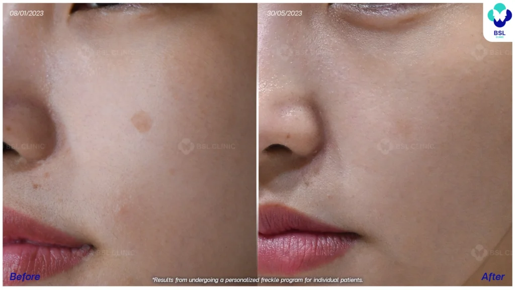 รีวิวรักษากระ