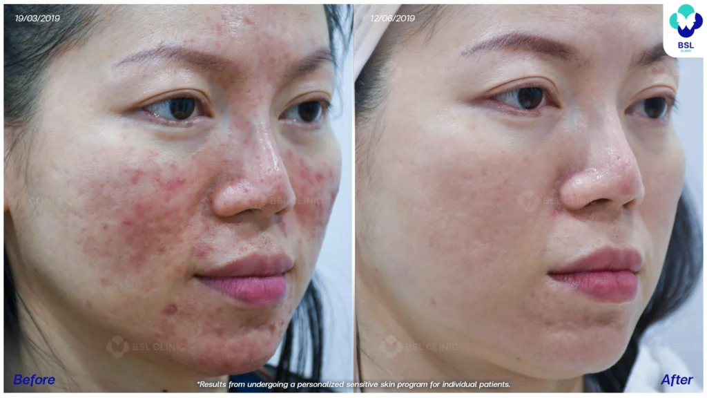 รีวิวรักษาผิวแพ้ง่าย