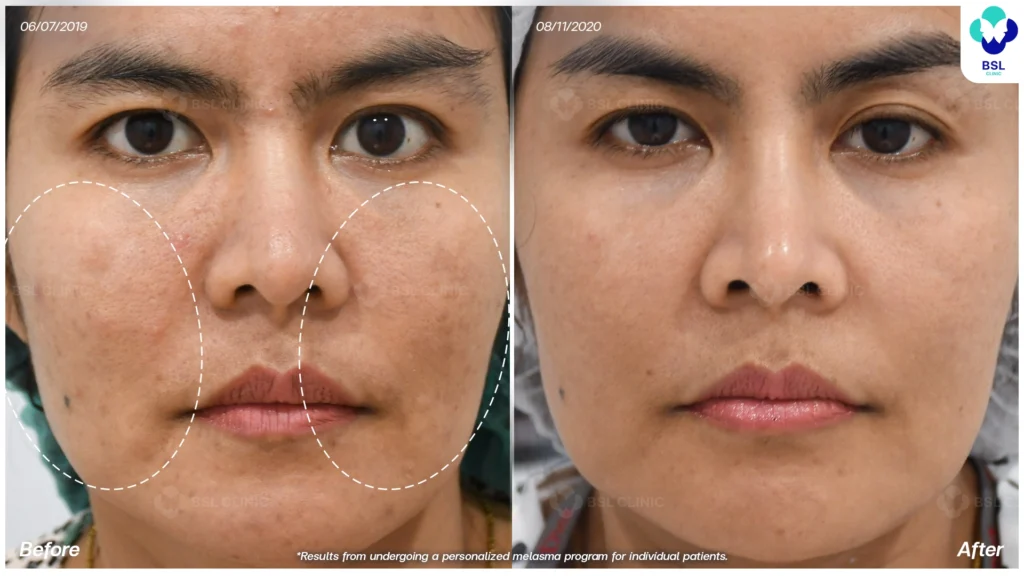 รีวิวรักษาฝ้า