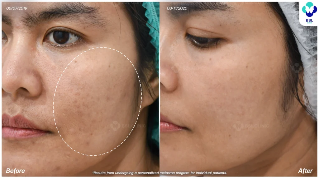 รีวิวรักษาฝ้า