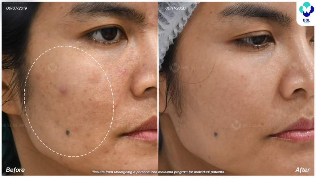 รีวิวรักษาฝ้า