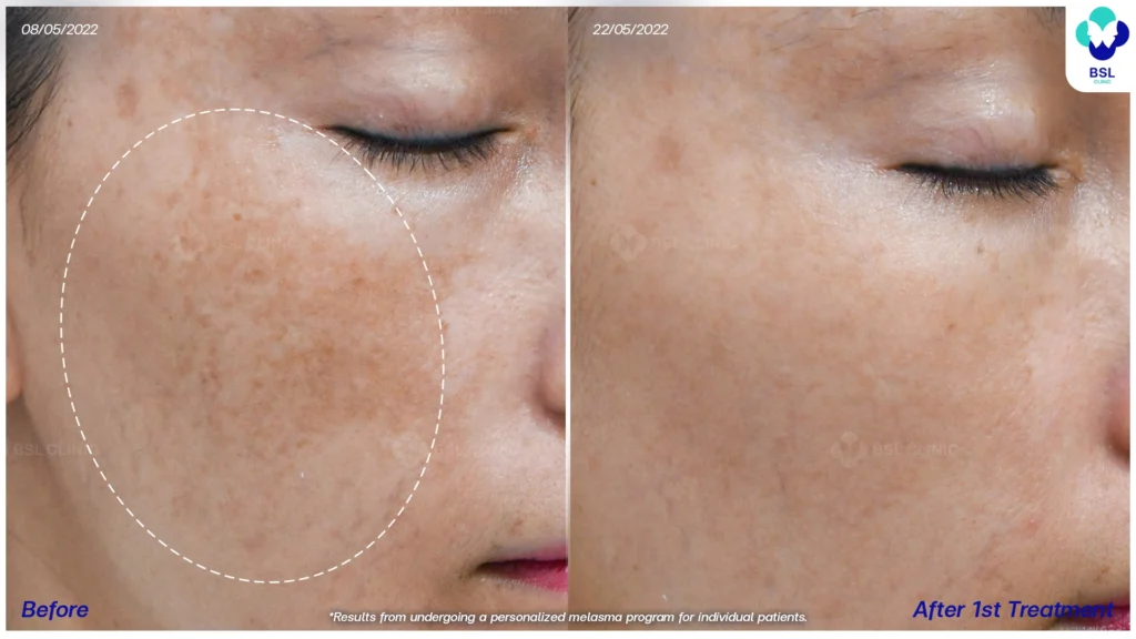 รีวิวรักษาฝ้า