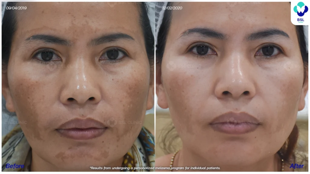 รีวิวรักษาฝ้า