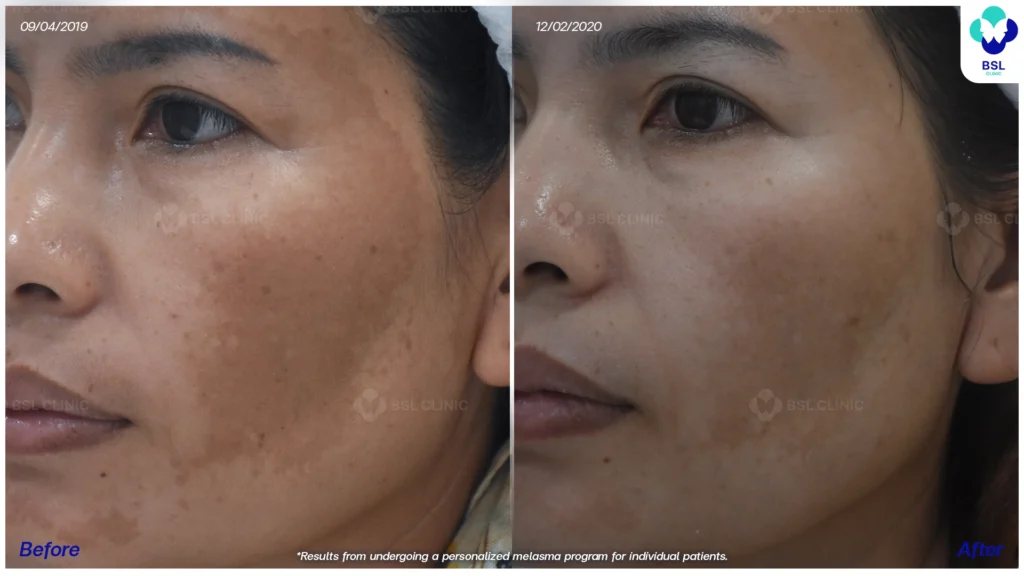 รีวิวรักษาฝ้า