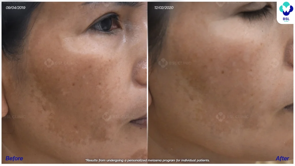 รีวิวรักษาฝ้า