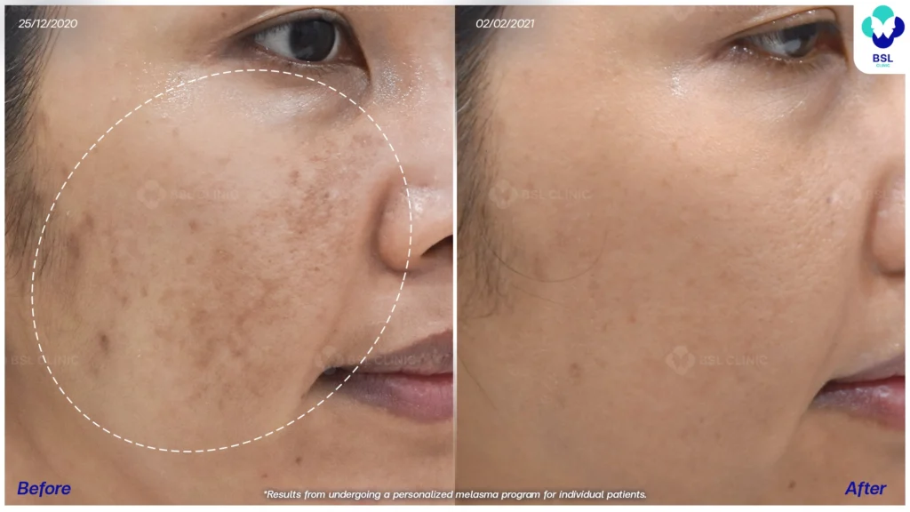 รีวิวรักษาฝ้า