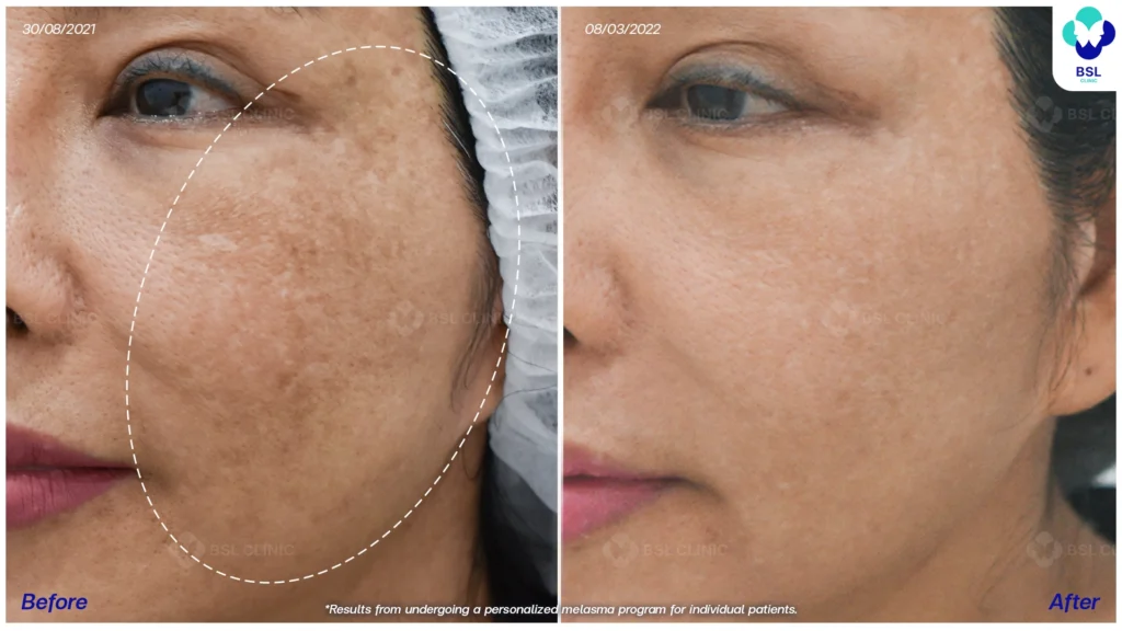 รีวิวรักษาฝ้า