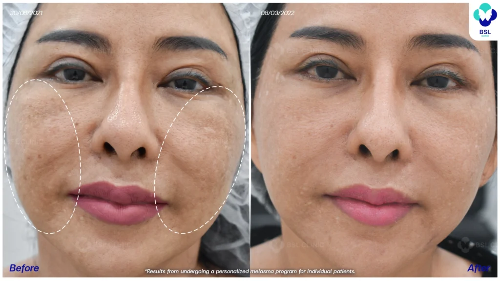 รีวิวรักษาฝ้า