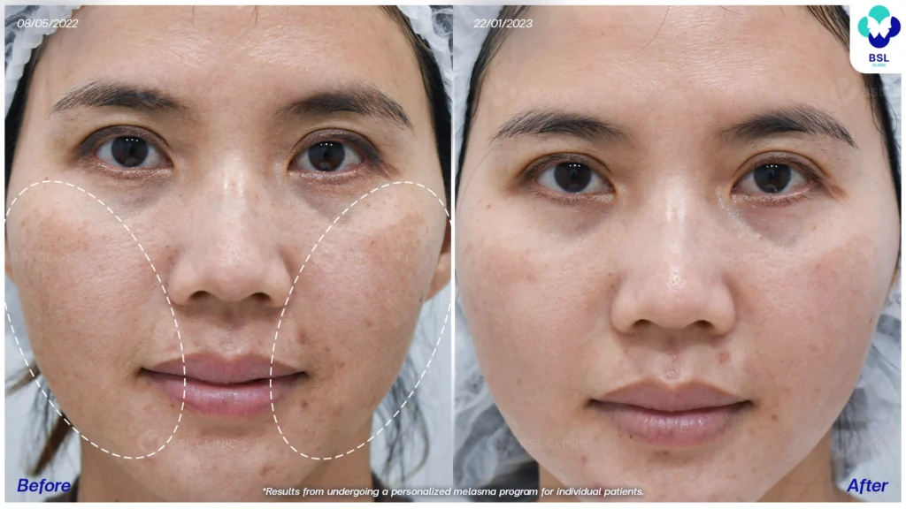 รีวิวรักษาฝ้า