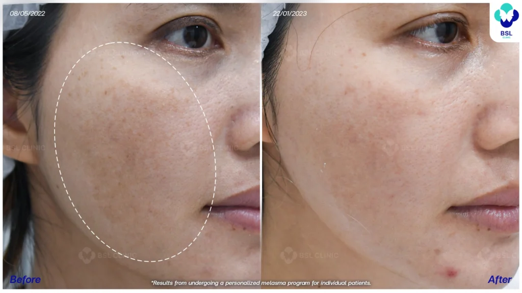 รีวิวรักษาฝ้า