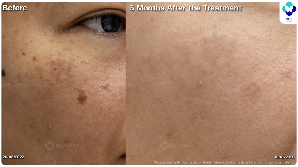 รีวิวรักษาฝ้า