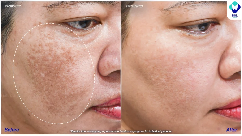 รีวิวรักษาฝ้า