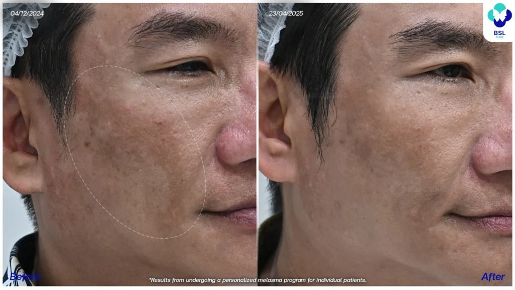 รีวิวรักษาฝ้า