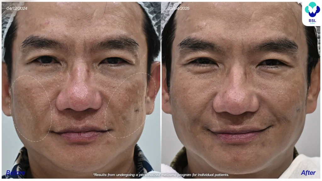 รีวิวรักษาฝ้า