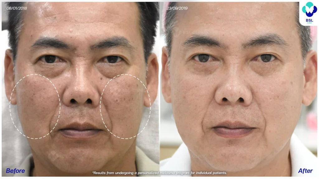 รีวิวรักษาฝ้า