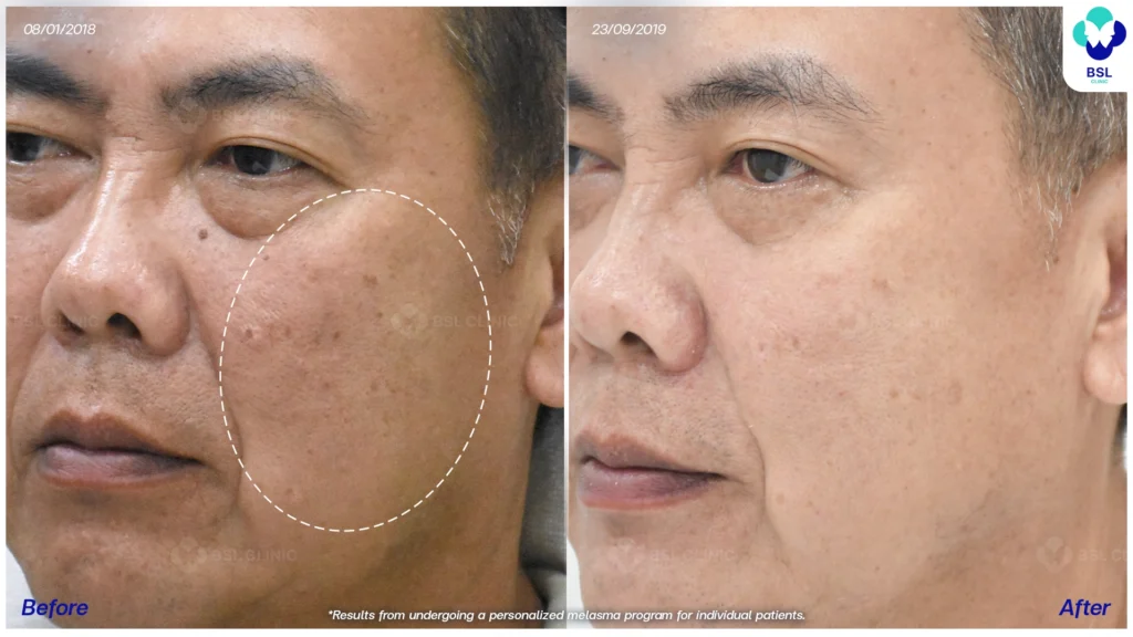 รีวิวรักษาฝ้า