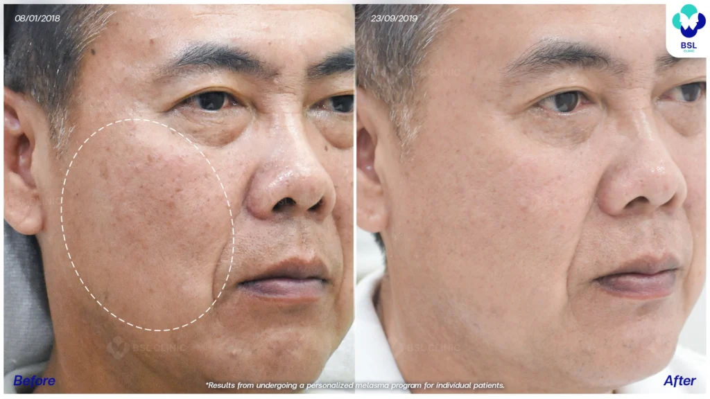 รีวิวรักษาฝ้า