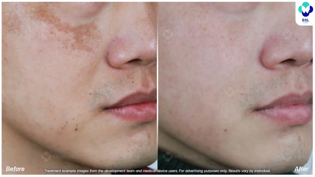 รีวิวรักษากระ