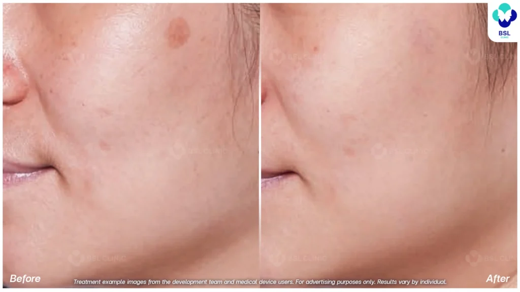 รีวิวรักษากระ