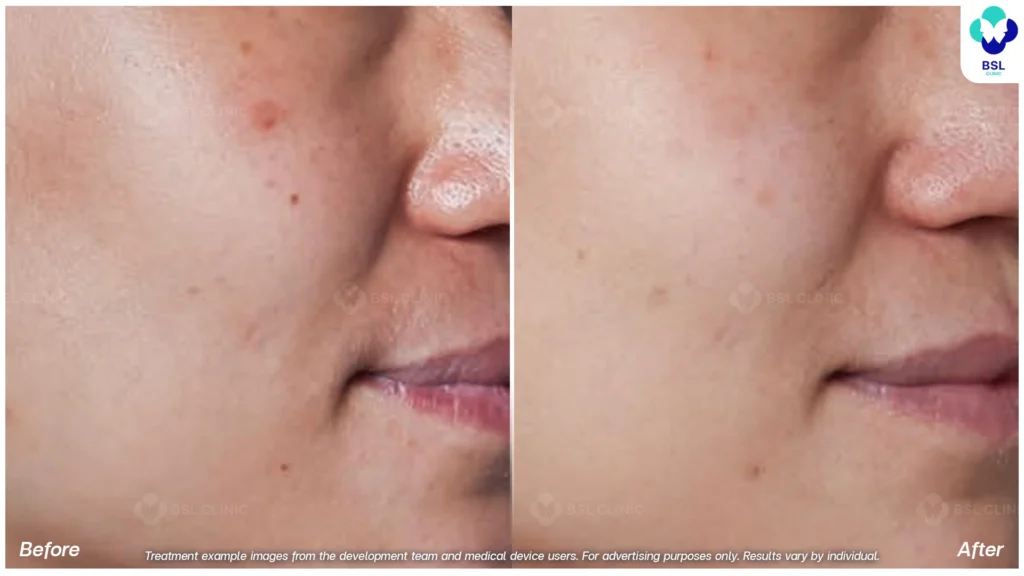 รีวิวรักษากระ