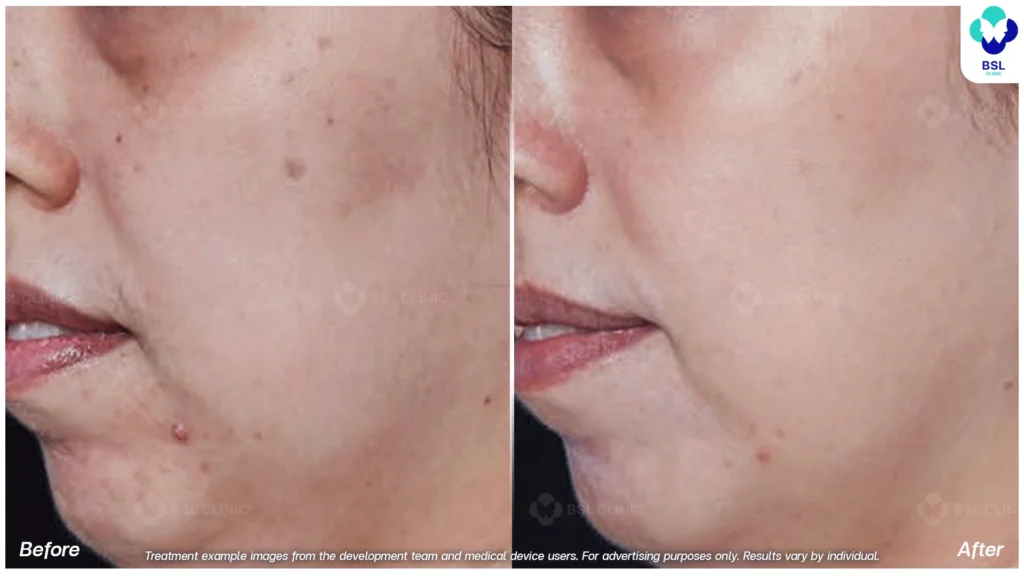 รีวิวรักษากระ