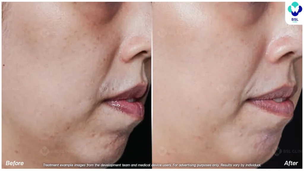 รีวิวรักษากระ