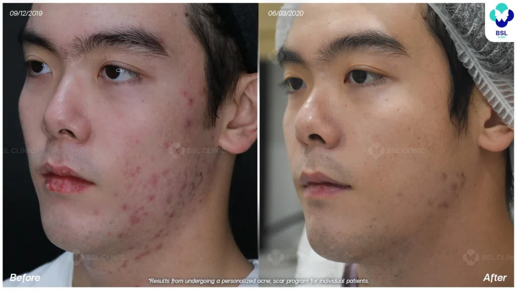 รีวิวรักษาสิวผู้ชาย