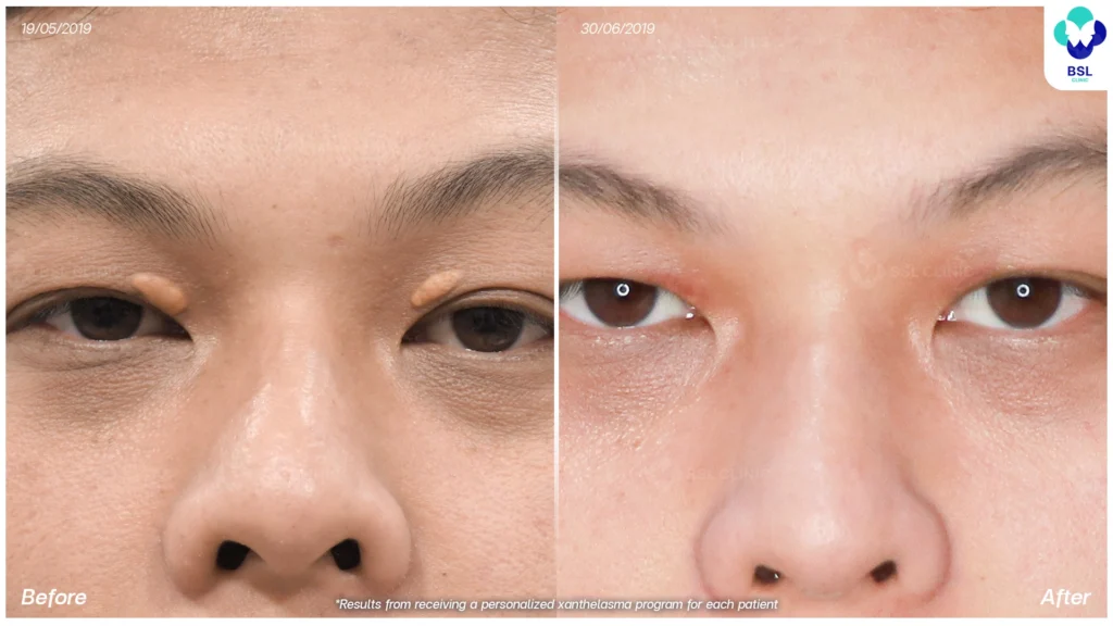 รักษาไขมันที่เปลือกตา