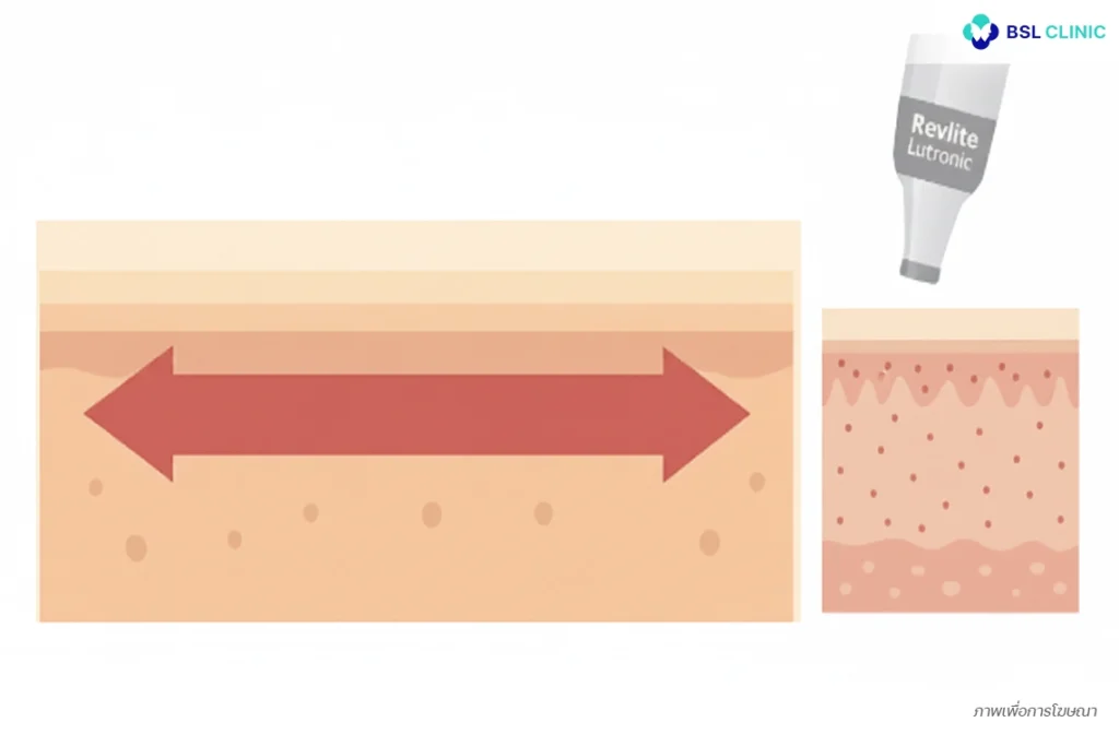 ลดความร้อนสะสมและลดผลข้างเคียงหลังทำ