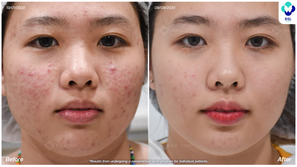 รีวิวรักษาสิว