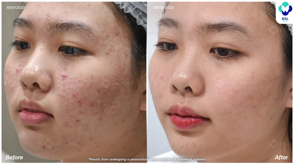 รีวิวรักษาสิว