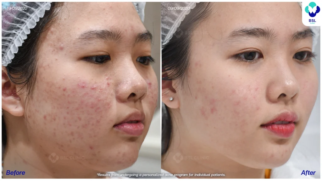 รีวิวรักษาสิว