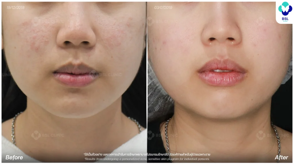 การดูแลผิว รีวิวผลการรักษาผิวแพ้ง่าย