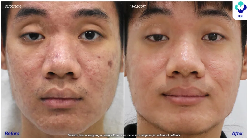 รีวิวรักษาสิว ฮอร์โมนผู้ชาย