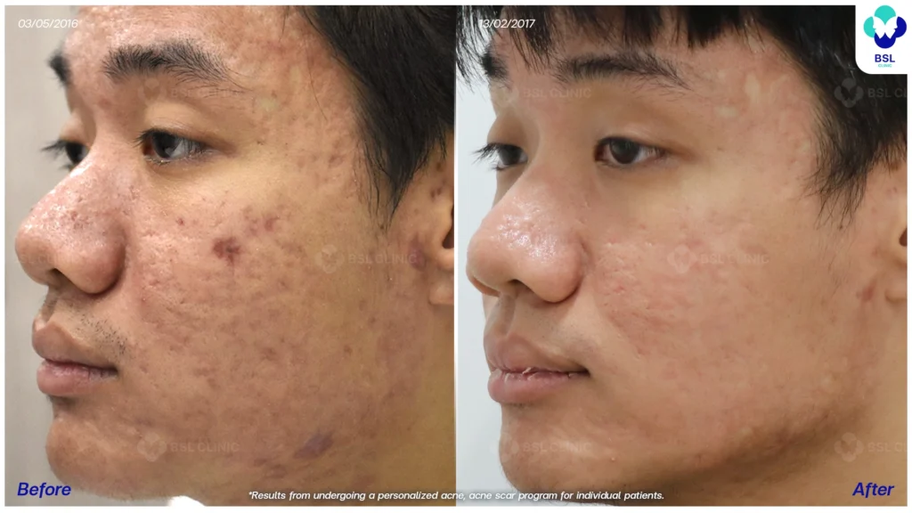 รีวิวรักษาสิว ฮอร์โมนผู้ชาย