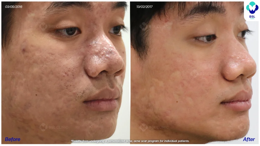 รีวิวรักษาสิว ฮอร์โมนผู้ชาย