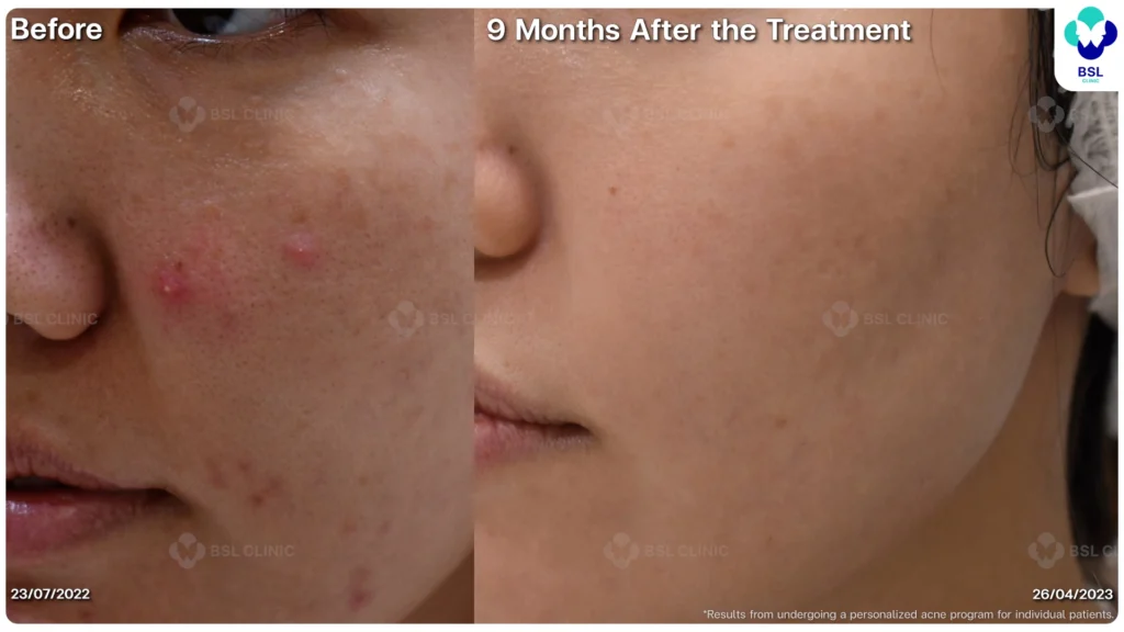 รีวิวรักษาสิว