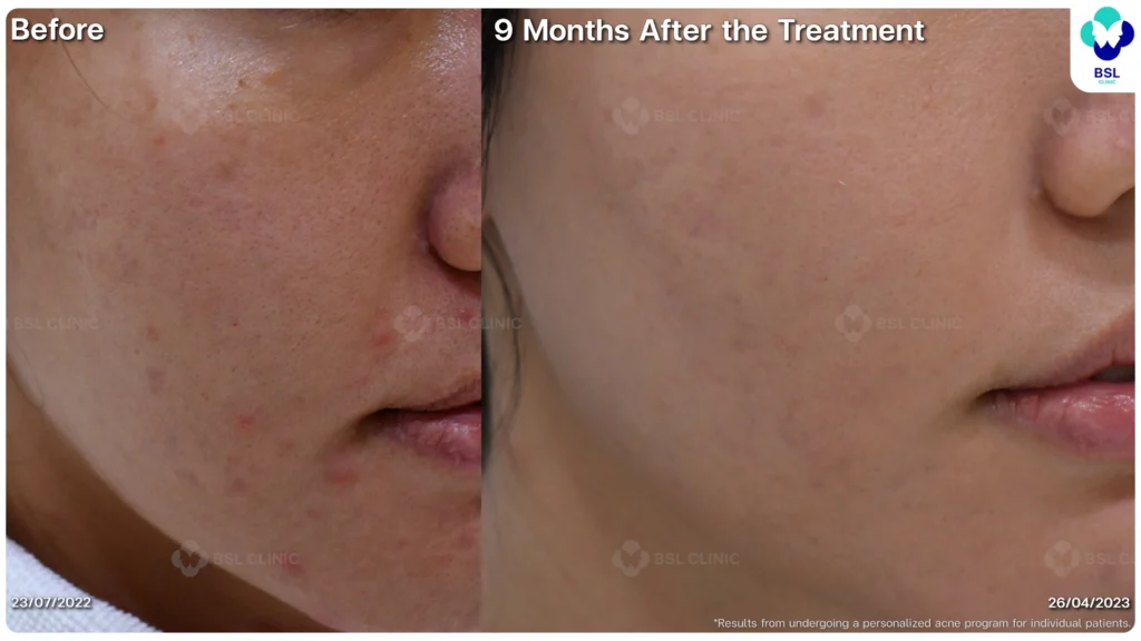 รีวิวรักษาสิว