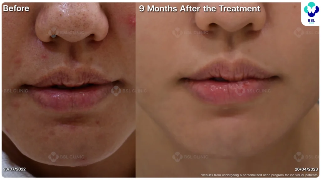 รีวิวรักษาสิว