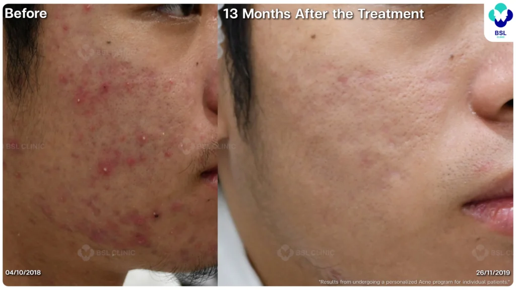 รีวิวรักษาสิว