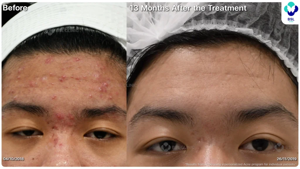 รีวิวรักษาสิว