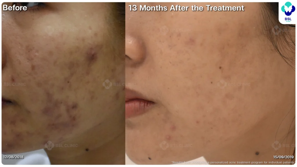 รีวิวรักษาสิว