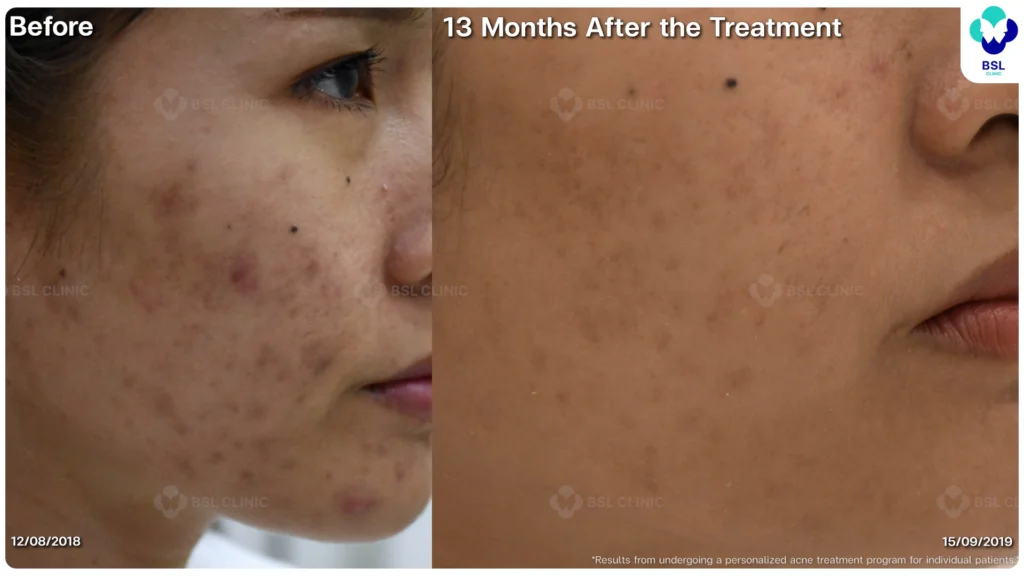 รีวิวรักษาสิว