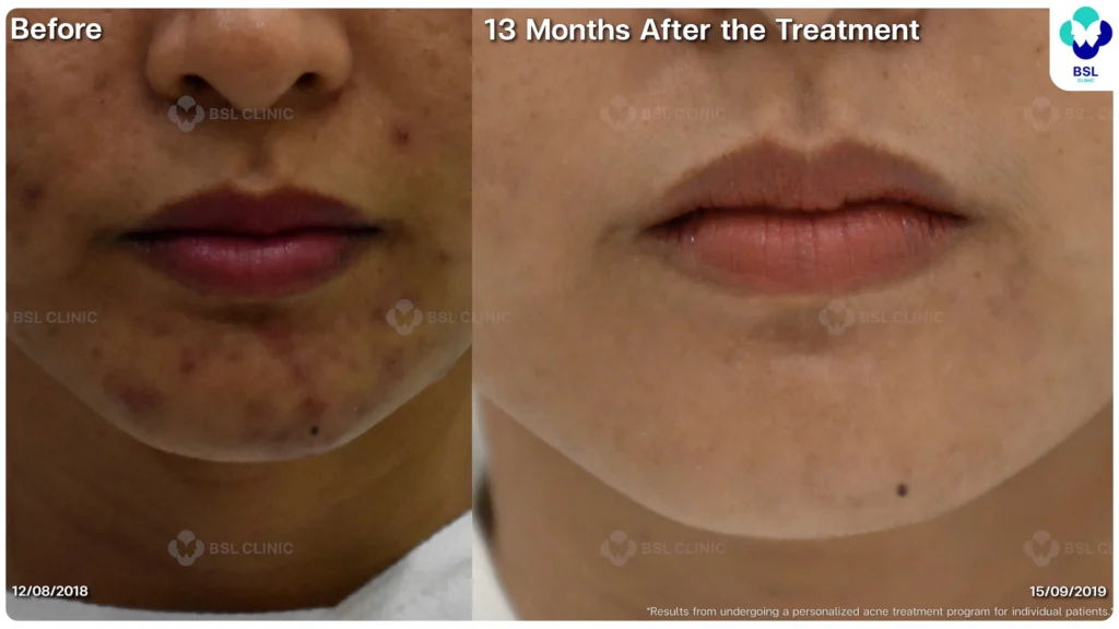 รีวิวรักษาสิว