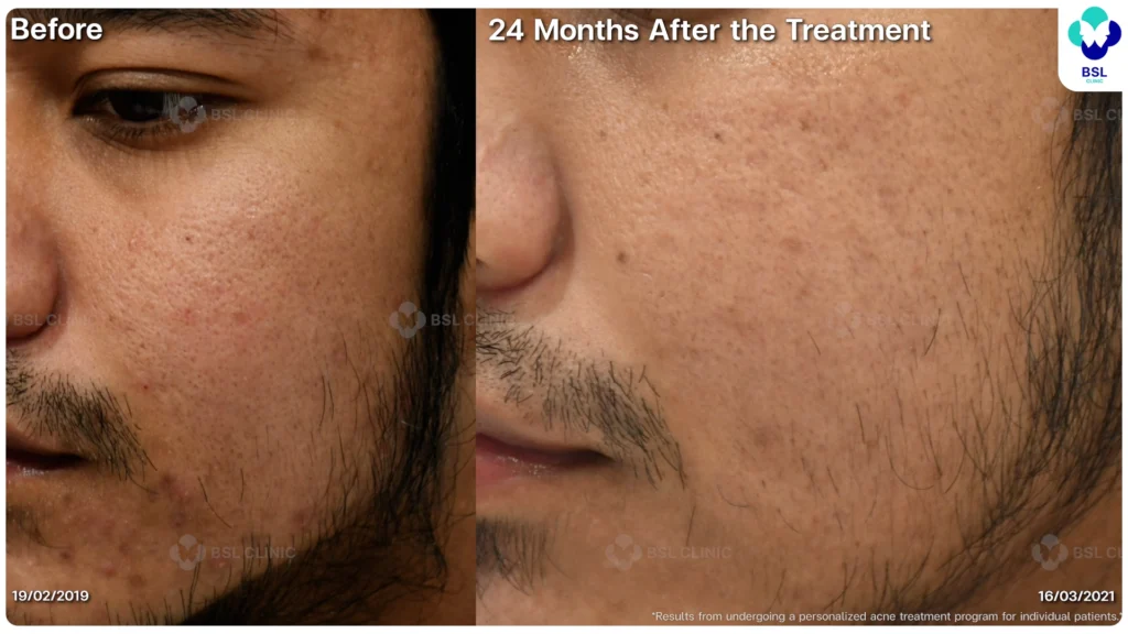 รีวิวรักษาสิว