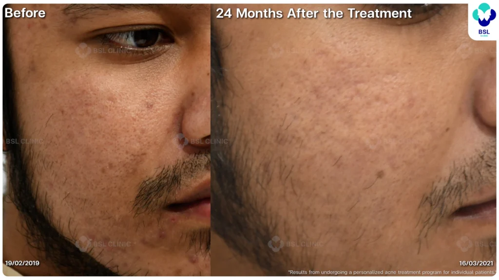 รีวิวรักษาสิว