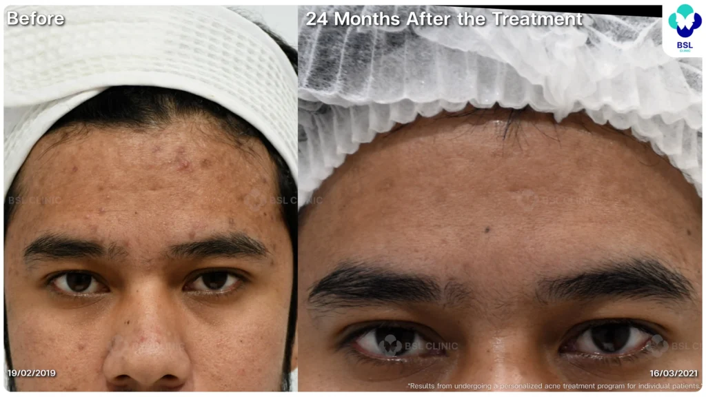 รีวิวรักษาสิว