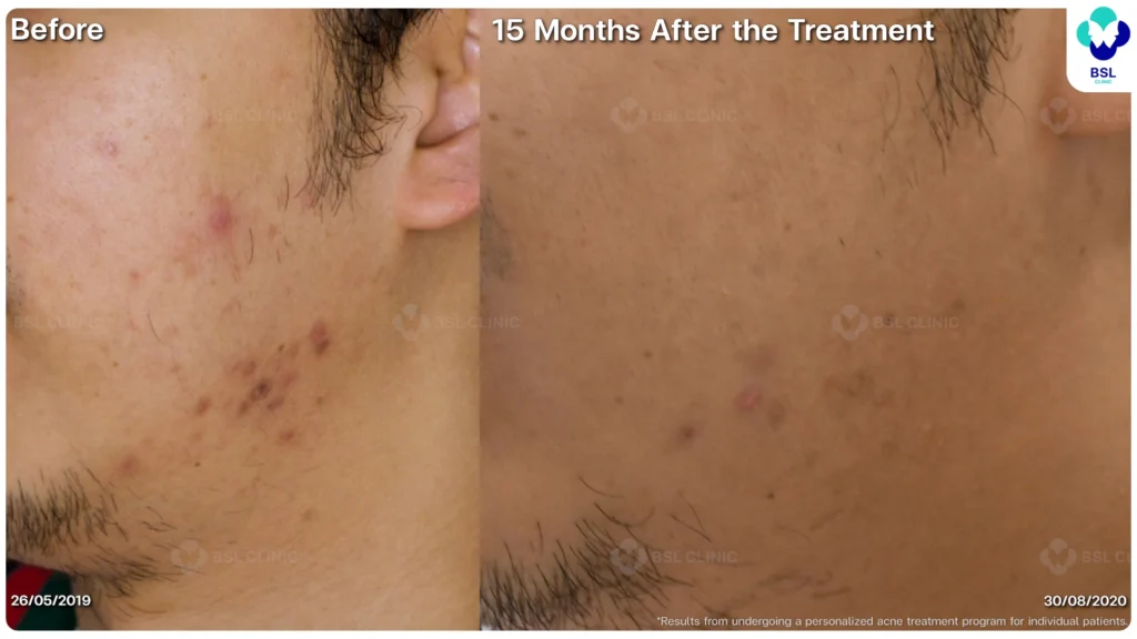 รีวิวรักษาสิว